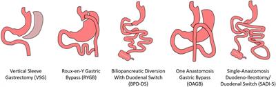 The role of bariatric and metabolic surgery in the development, diagnosis, and treatment of endometrial cancer